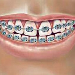 Colutorios ortodoncia